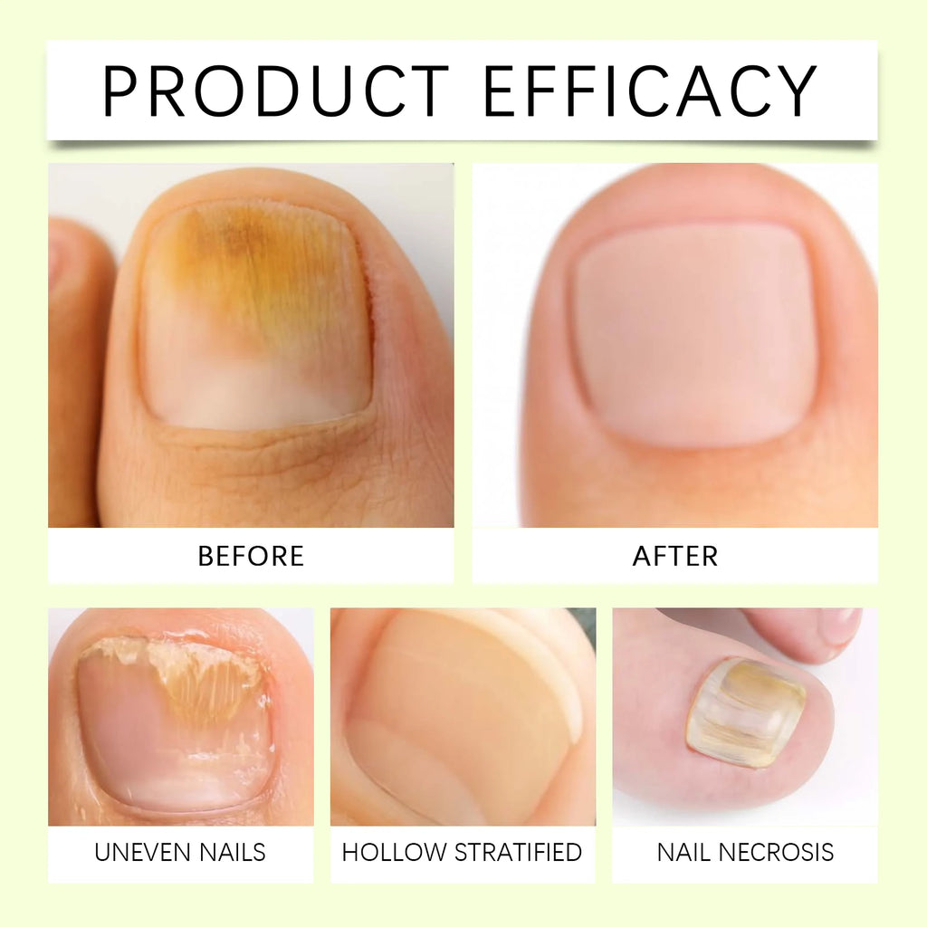 Nail Fungus Repair Serum Foot Alleviate Liquid Toe Nails Fungal Removal Gel Anti Infection Paronychia Onychomycosis Cream Qme