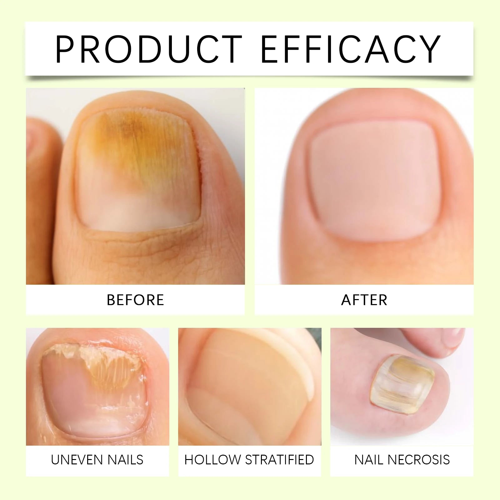 Nail Fungus Repair Serum Foot Alleviate Liquid Toe Nails Fungal Removal Gel Anti Infection Paronychia Onychomycosis Cream Qme