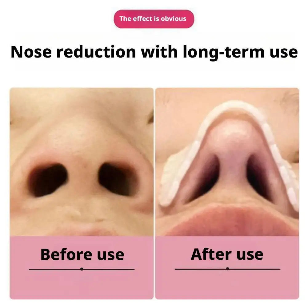 1 2 Packs Thermoplastic Nasal Splints Trapezoid Nose Brace External Qme
