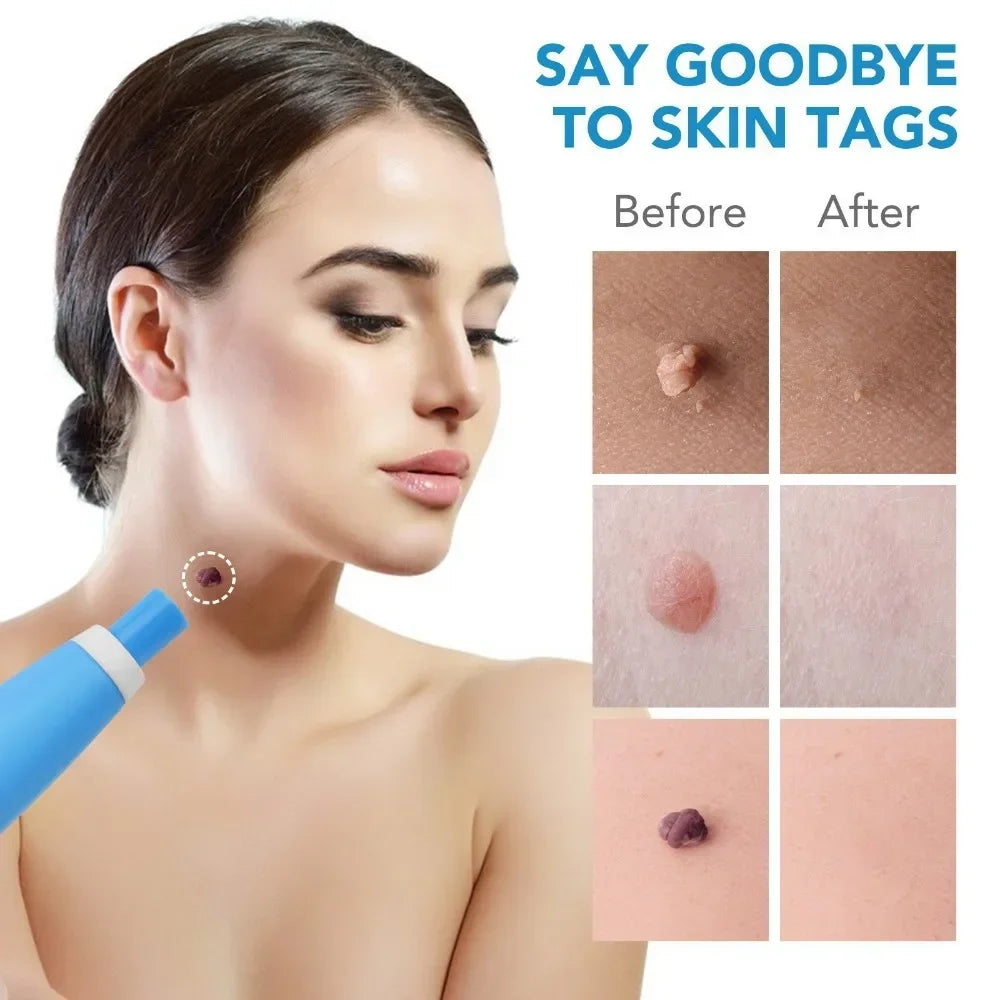 2 In1 Painless Auto Skin Tag Mole Wart Removal Cleaning Tools Face Qme