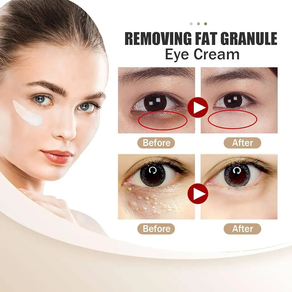 Fat Granules Remover Eye Cream Anti-Puffiness Anti Inflammatory Reduce Dark Circles Eyebags Fade Lines Moisturizing Eye Care Qme