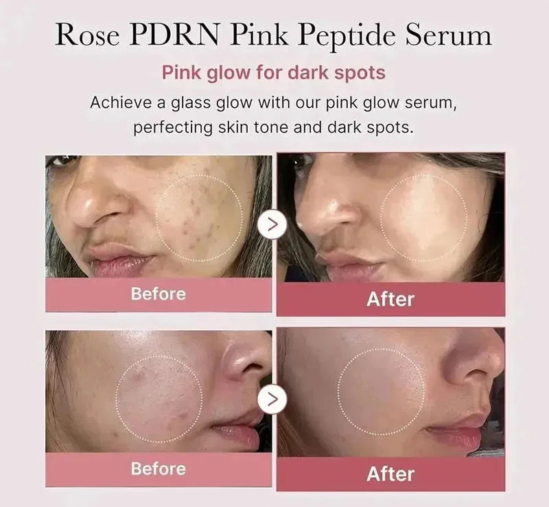 Niacinamide Dark Spot Remove Serum Face Freckle Melanin Correcting Moisturizing Brightening Anti Pigmentation Repair Skin Care Qme