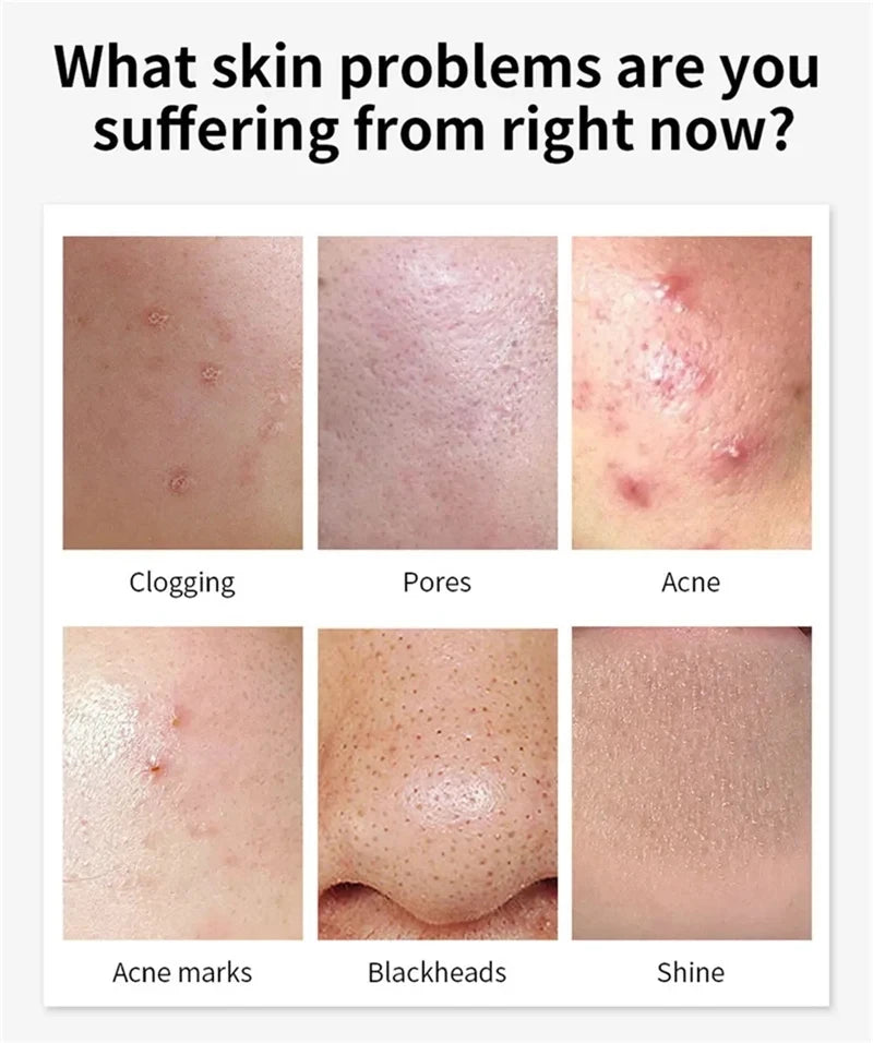 Salicylic Acid Acne Faded Face Cream Reduce Pimple Spots Deep Cleaning Pore Anti-acne Scar Oil Control Moisturizer Skin Care Qme