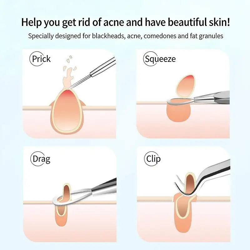 Ultra-precise Acne Blackhead Removal Tool Pimple Tweezers Effective Qme