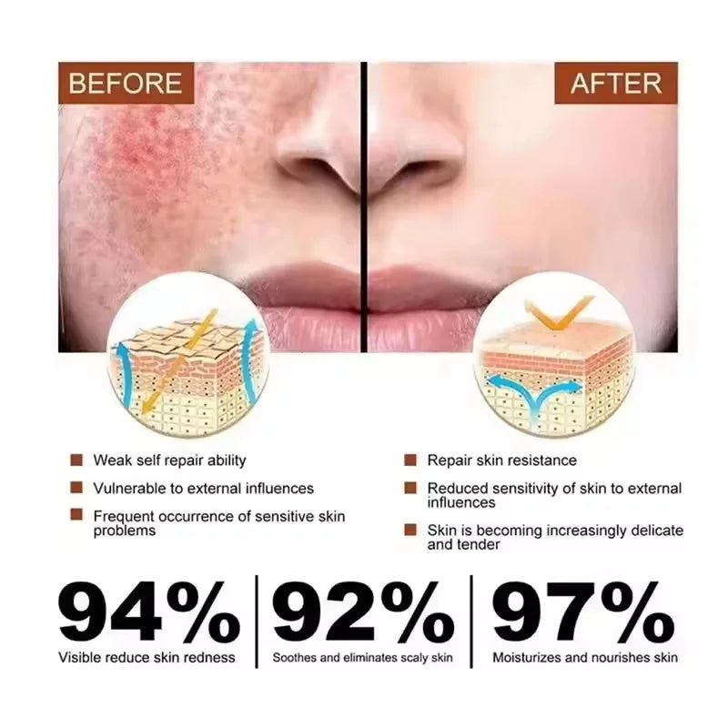 Facial Redness Repair Serum Improve Sensitive Skin Dryness Moisturizer Hydrating Sooth Lotion Removal Rosacea Korean Cosmetics Qme