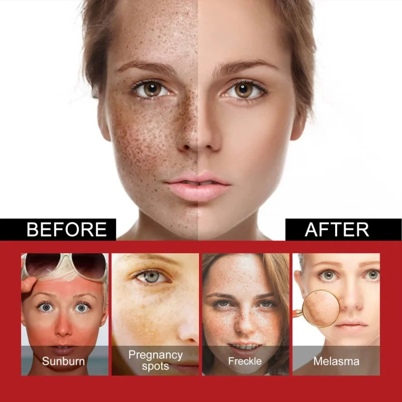 Whitening Freckles Face Cream Removal Melasma Dark Spots Corrector Lighten Melanin Pigmentation Brighten Anti-Aging Beauty Care Qme
