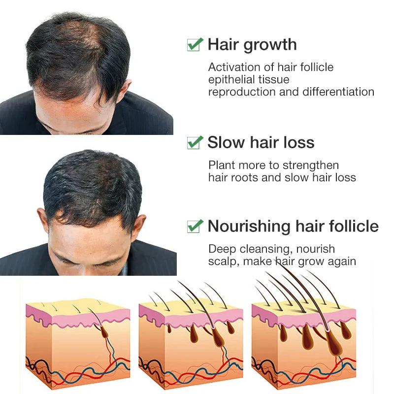 Hair Growth Serum Anti Loss Regrowth Hair Growth Oil Prevent Baldness Repair Damage Scalp Massage Moisturizing Nourish Hair Care Qme