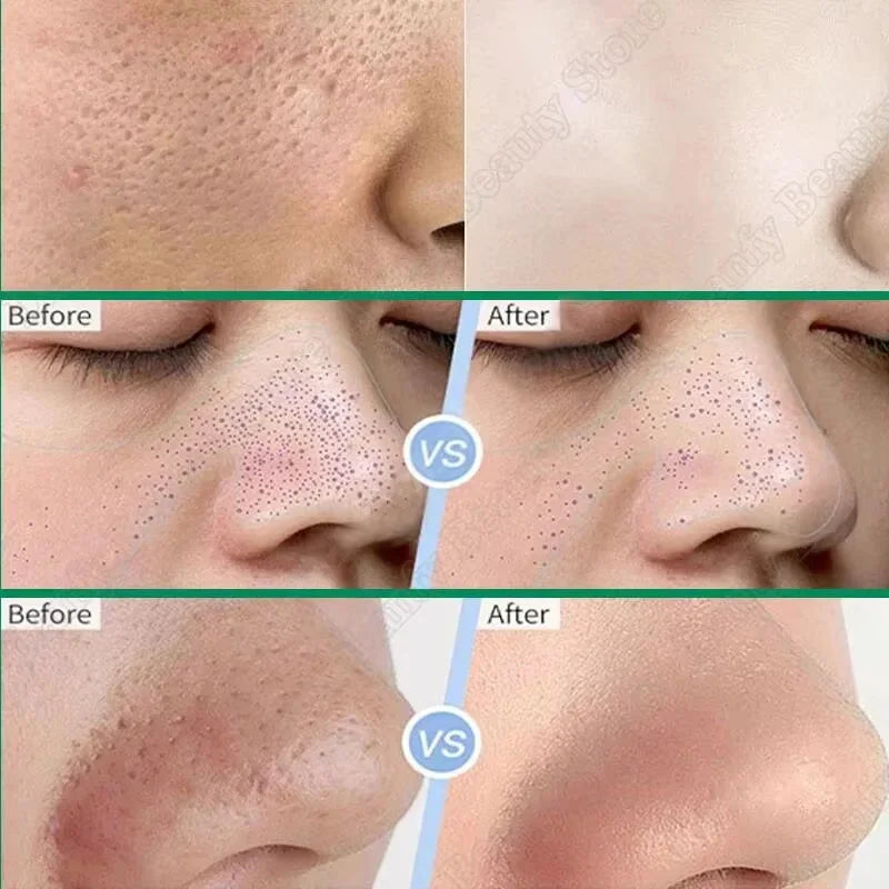 Salicylic Acid Pore Clearing Cream Shrink Pores Remove Blackheads Acne Brighten Moisturizing Smooth Skin Care Korean Products Qme
