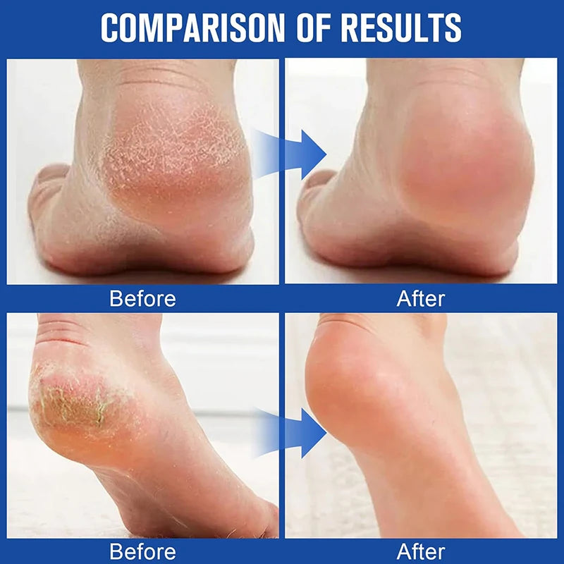 Foot Repair Cream Cracked Skin Intensive Hand Suitable Dry Winter Qme