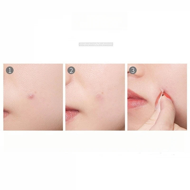 36/72/180/360/720 Pcs Round Acne Patch Hydrocolloid Anti Acne Patches Waterproof Face Skin Care Blackhead Remover Pimple Patches Qme