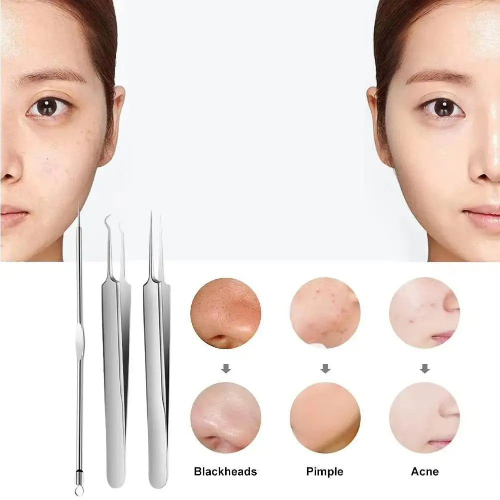 Acne Needle Blackhead Clip Remover Extraction Pore Black Head Clean Qme