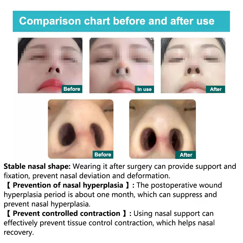 Postoperative Rhinoplasty Nostril Support Silicone Shaping Crooked Qme