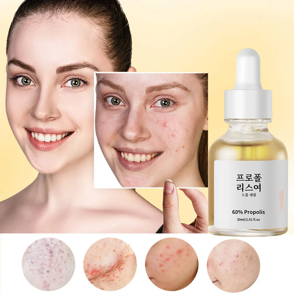 Propolis Salicylic Acid Acne Treatment Essence Pore Refining Qme