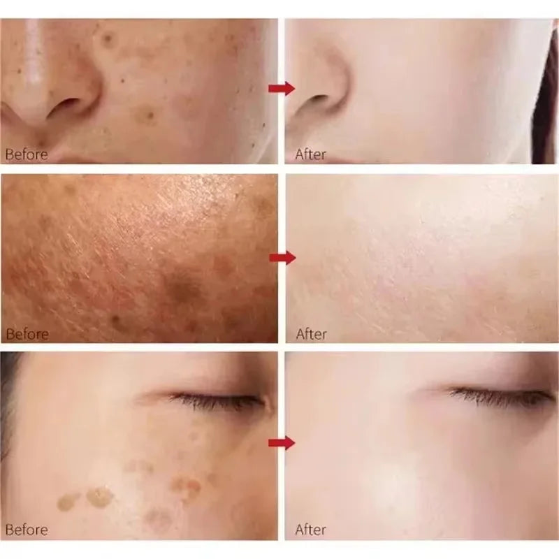 Turmeric Freckle Removing Whitening Essence Fade Pigmentation Melasma Dark Spots Corrector Repair Serum Korean Skin Care Qme