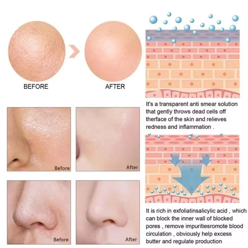 Pore Shrink Face Serum Remove Blackheads Acne Acidity Oil Control Repair Essence Moisturizing Nourish Pores Firming Facial Care Qme