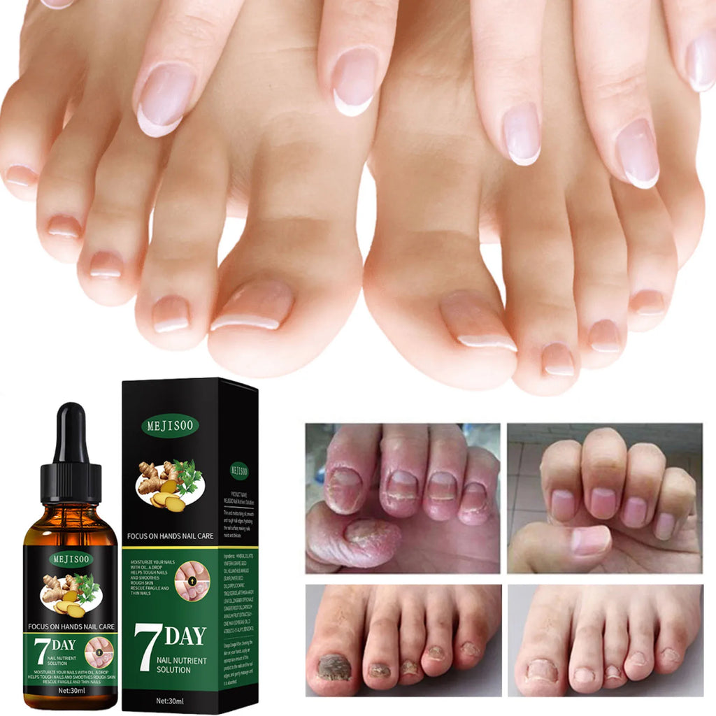 Nail Fungus Repair Serum Foot Alleviate Liquid Toe Nails Fungal Removal Gel Anti Infection Paronychia Onychomycosis Cream Qme
