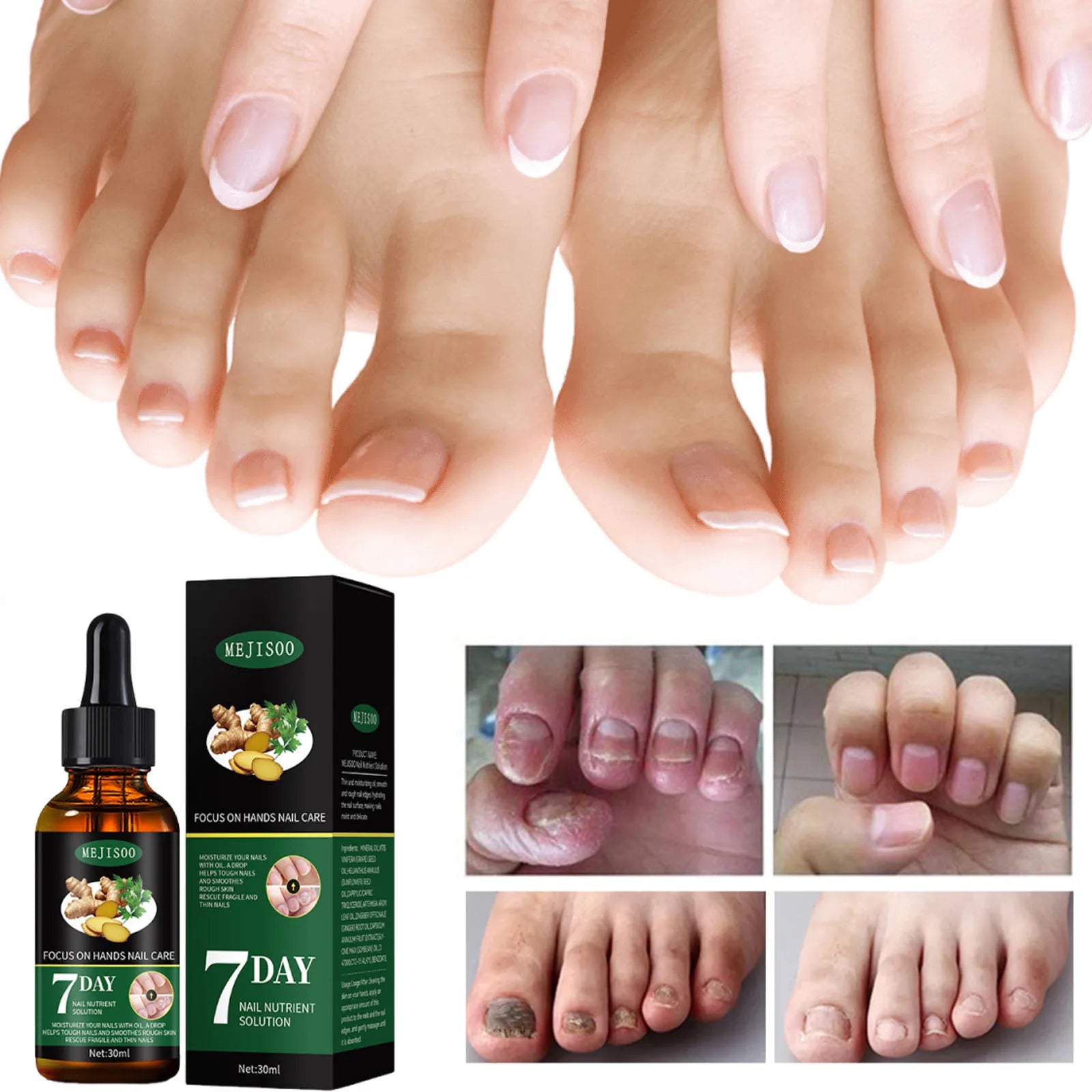 Nail Fungus Repair Serum Foot Alleviate Liquid Toe Nails Fungal Removal Gel Anti Infection Paronychia Onychomycosis Cream Qme