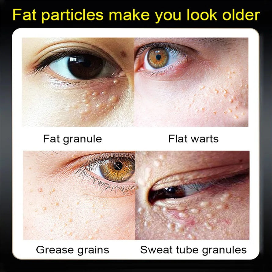 Fat Granules Remover Eye Cream Anti-Puffiness Anti Inflammatory Reduce Dark Circles Eyebags Fade Lines Moisturizing Eye Care Qme