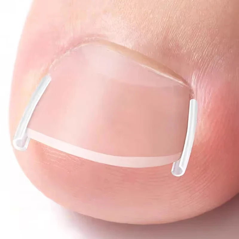 Inward Toe Nail Shaping Tool Invisible Care Pad Groove Adjust Clip Qme