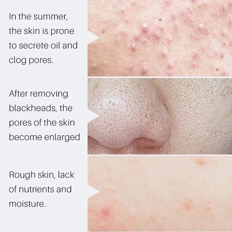 Salicylic Acid Pore Shrinking Serum Quick Elimination Large Pores Remove Blackhead Acne Tighten Smooth Skin Korean Care Product Qme