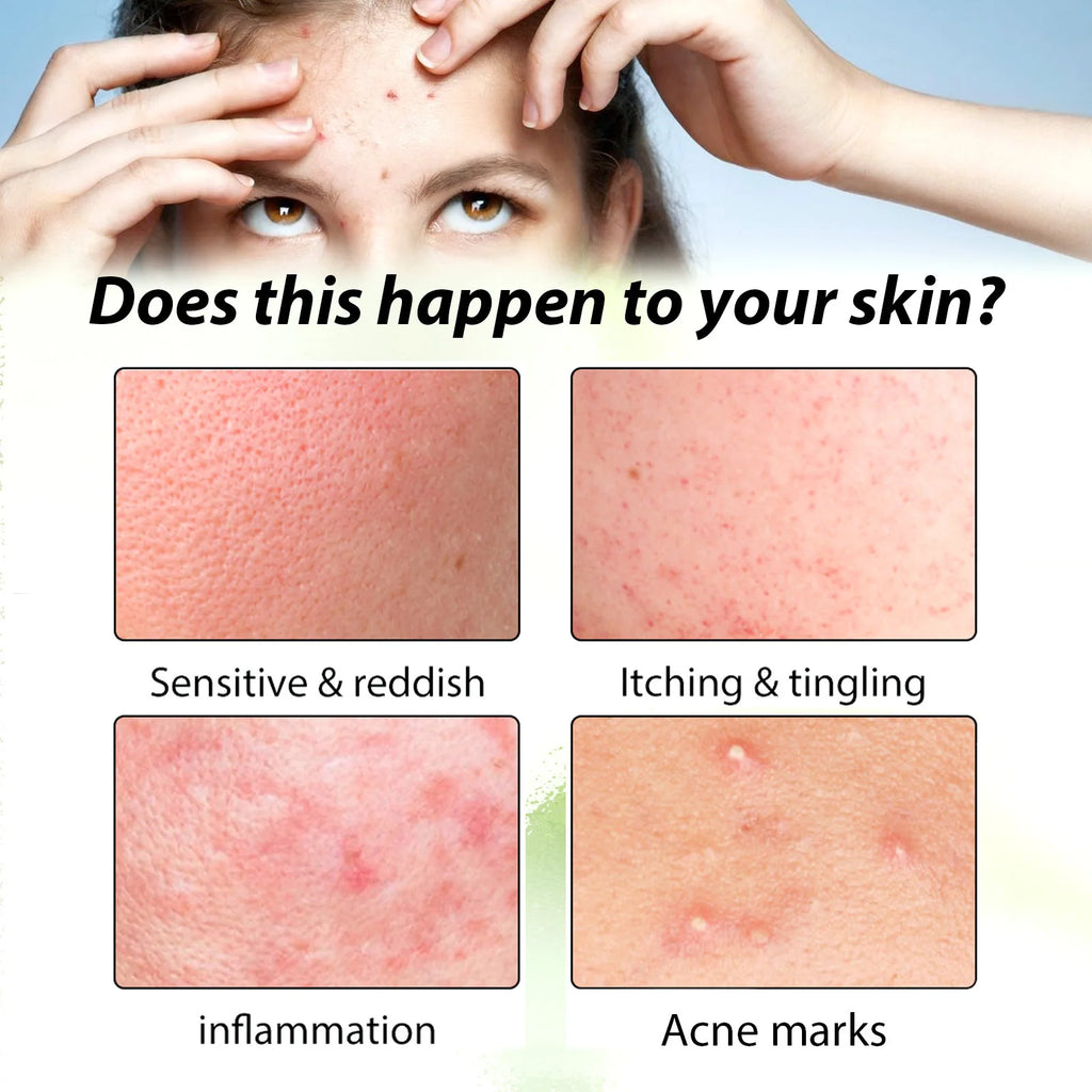 Acne Face Cream Pimple Treatment Oil Control Repair Redness Remove Blackhead Smooth Hydrating Moisturizing Pore Shrinking Serum Qme