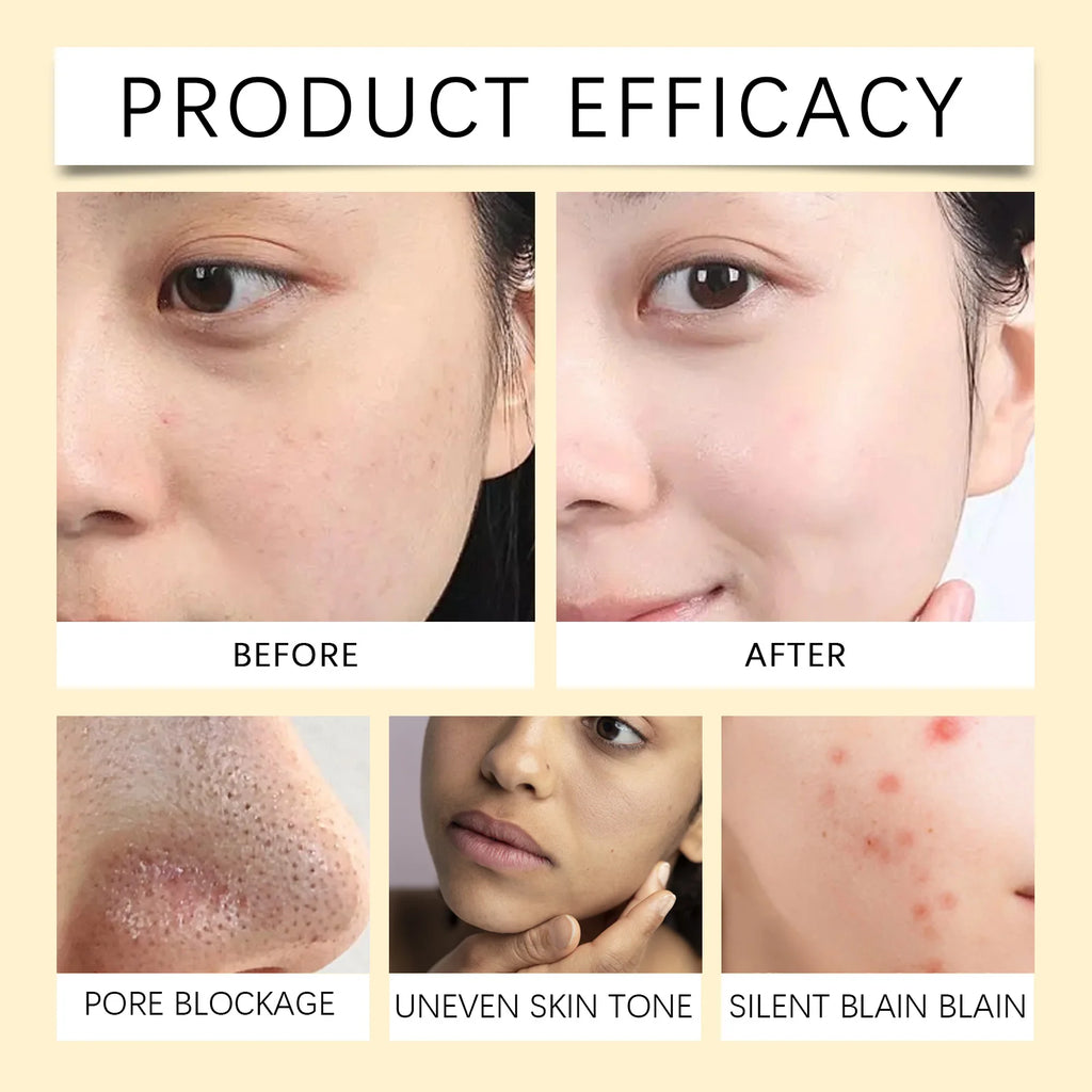Vitamin C Exfoliating Facial Mask Shrink Pore Brightening Turmeric Exfoliating Facial Mask Improve Pore Deep Cleaning Facialmask Qme