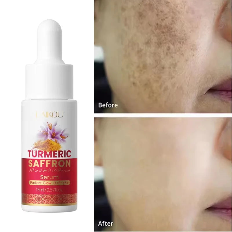Turmeric Freckle Removing Whitening Essence Fade Pigmentation Melasma Dark Spots Corrector Repair Serum Korean Skin Care Qme