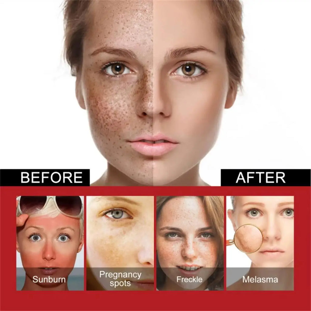Whitening Freckle Cream Remove Dark Spots Anti Freckle Face Creams Niacinamide Fade Pigmentation Melasma Brighten Skin Care 20g Qme