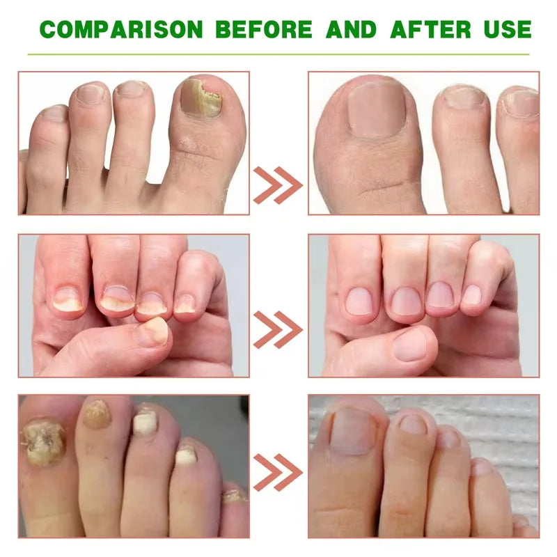Fungal Nail Treatment Serum 7 Days Fungus Removal Treating Paronychia Liquid Anti Gray Nails Infection Foot Repair Care Tools Qme