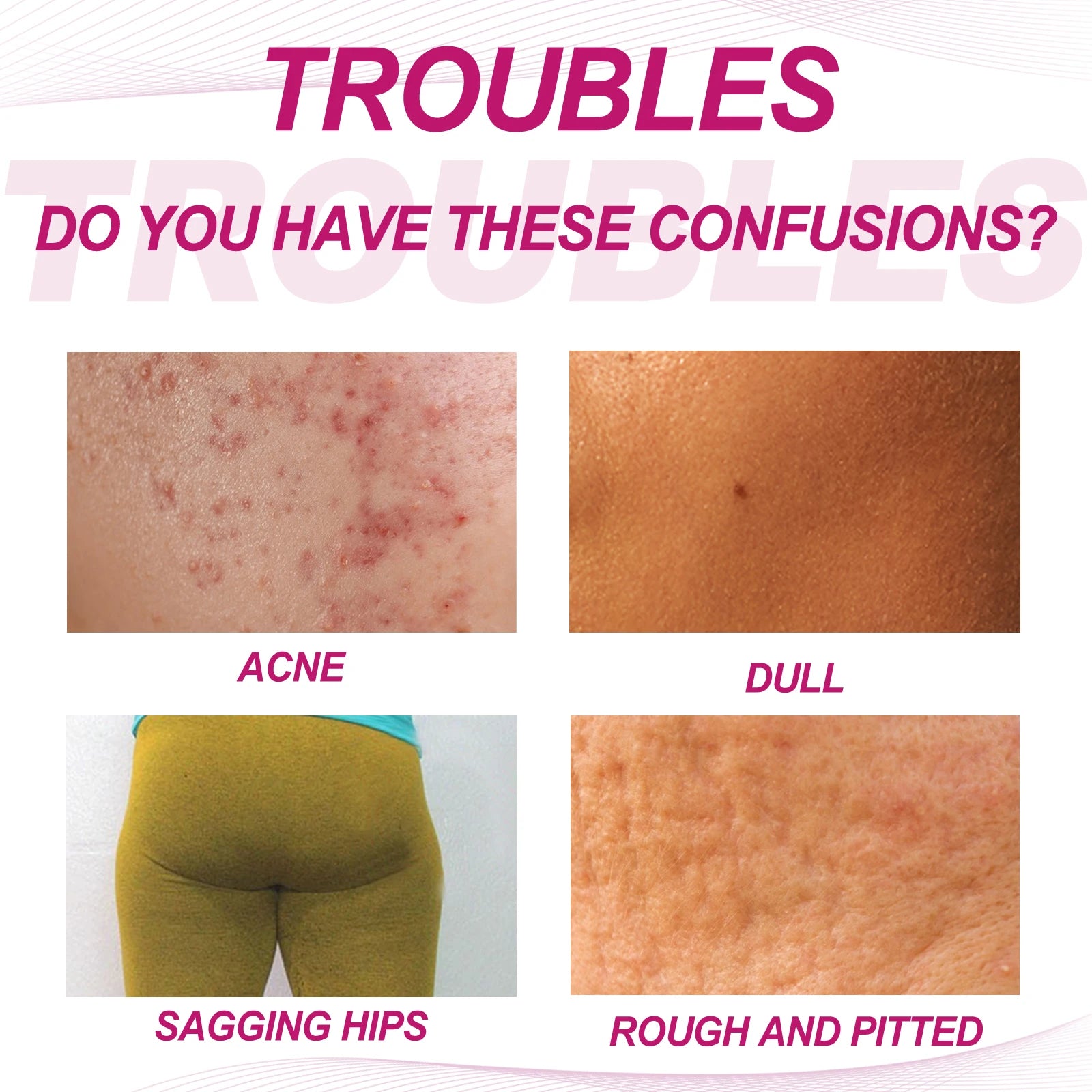 Butt Thigh Acne Cream Remove Pimples Moisturizing Clarifying Brightening Smoothing Skin Care Thigh Acne Removal Cream Qme