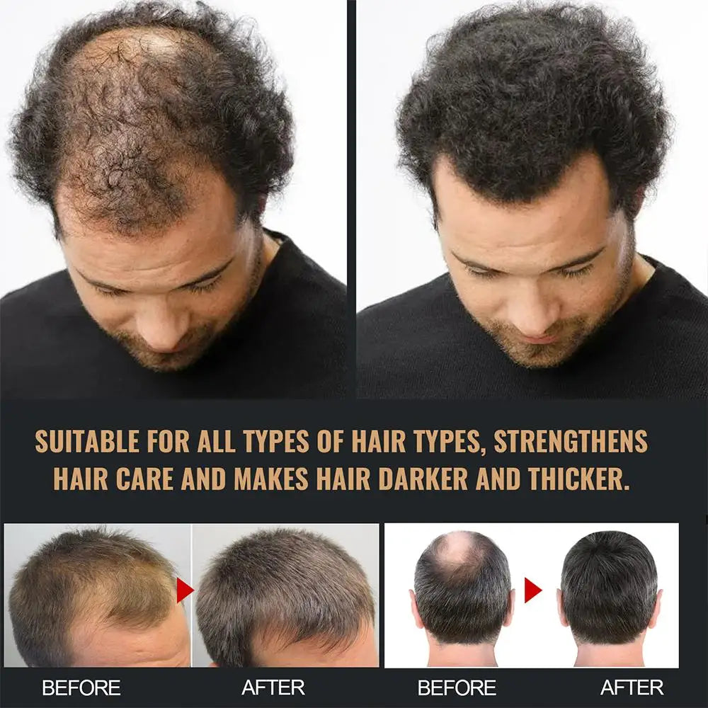 2PCS Anti Baldness Shampoo Thickening Shampoo Root Activator Shampoo Nourish Hair Regrowth Shampoo For Thinning Hair & Hair Loss Qme