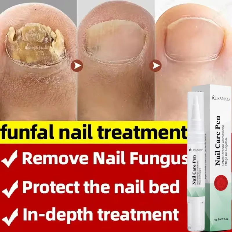 Nail Fungal Treatment Serum Foot Toe Nail Fungus Removal Essential Oil Anti Infection Onychomycosis Paronychia Repairing Care Qme