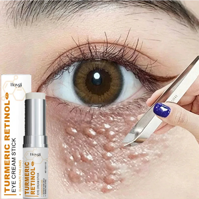 Fat Granules Remover Eye Cream Anti-Puffiness Anti Inflammatory Reduce Dark Circles Eyebags Fade Lines Moisturizing Eye Care Qme