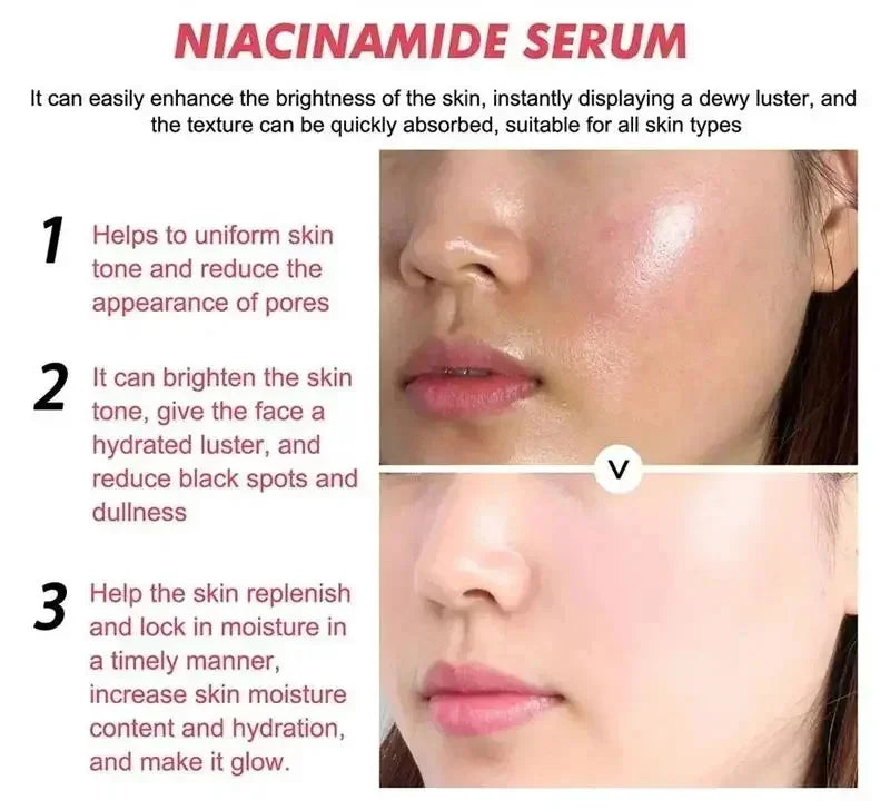 Niacinamide Dark Spot Remove Serum Face Freckle Melanin Correcting Moisturizing Brightening Anti Pigmentation Repair Skin Care Qme