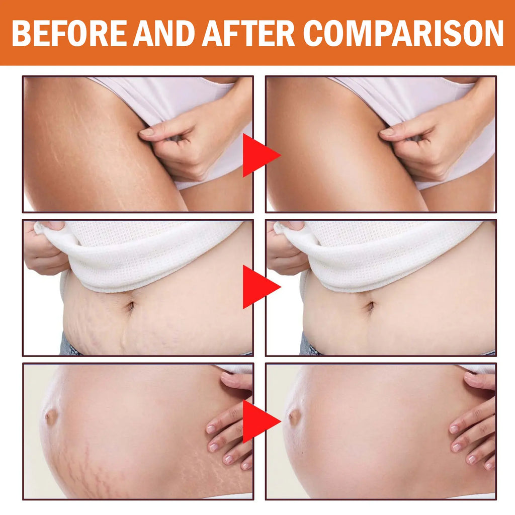100g Stretch Marks Permanent Removal Cream Maternity Pregnant Women Pregnancy Anti-Winkle Smooth Repair Firming Skin Body Care Qme