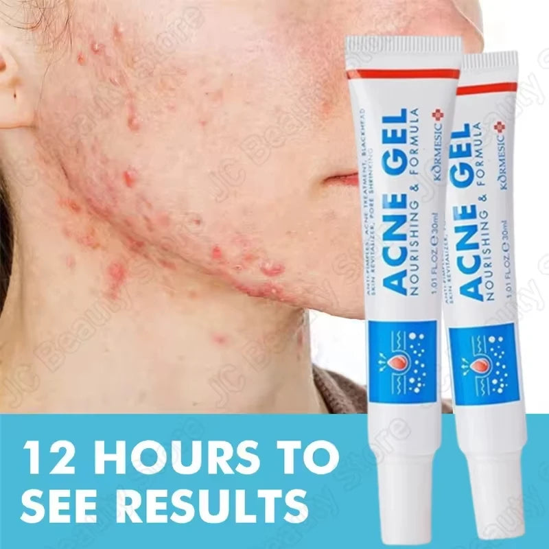 Salicylic Acid Acne Faded Face Cream Reduce Pimple Spots Deep Cleaning Pore Anti-acne Scar Oil Control Moisturizer Skin Care Qme