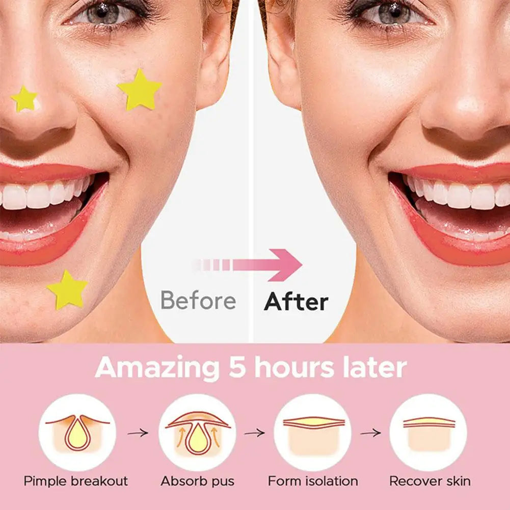 New 600pcs Star Acne Patch Mild Non-irritating Lightens Acne For Blackheads Closed Comedones Hydrocolloid Acne Sticker S0U6 Qme