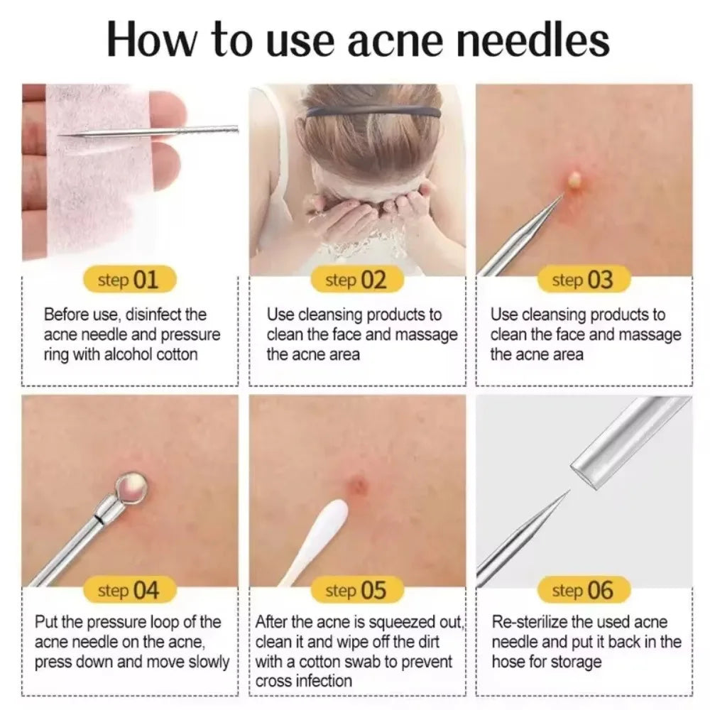 Acne Needle Blackhead Clip Remover Extraction Pore Black Head Clean Qme