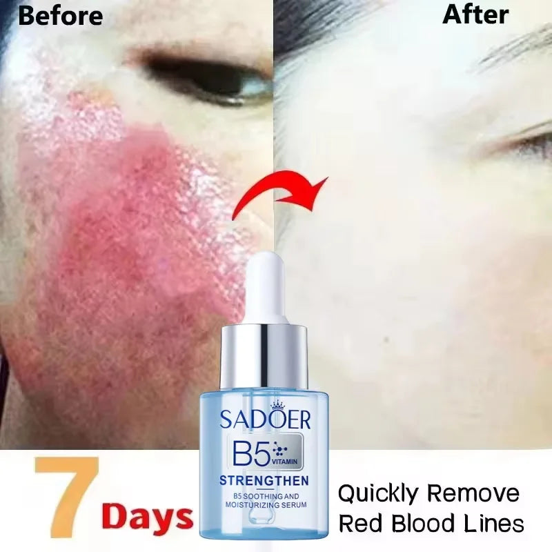 Facial Redness Repair Serum Improve Sensitive Skin Dryness Moisturizer Hydrating Sooth Lotion Removal Rosacea Korean Cosmetics Qme