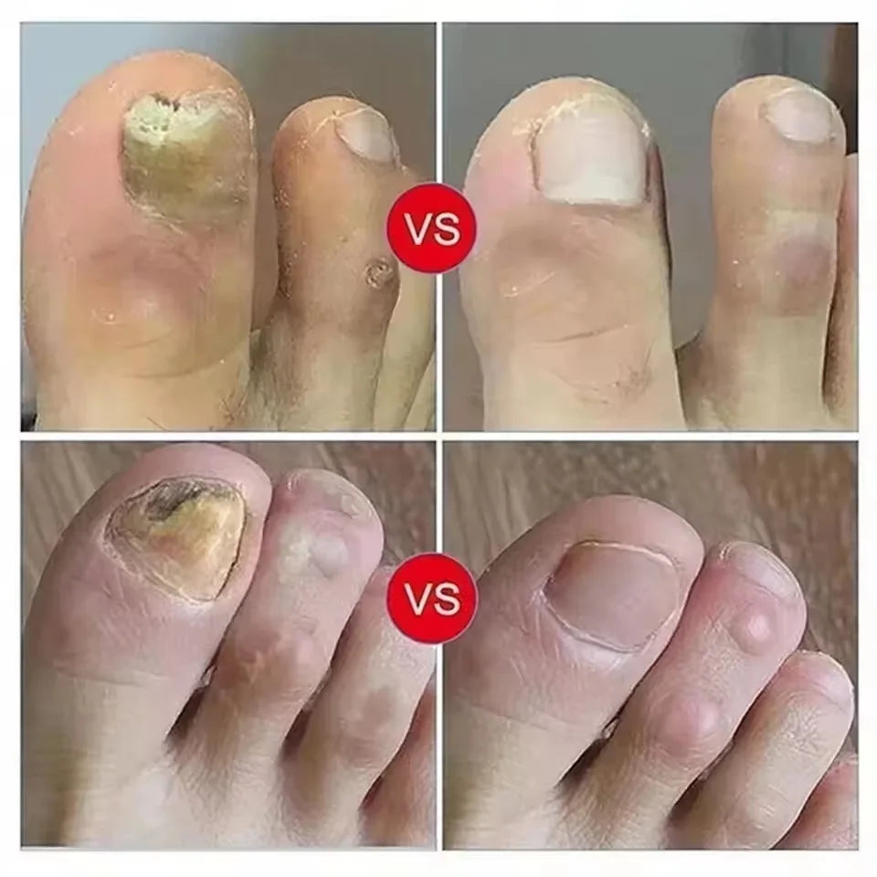 Nail Fungal Treatment Serum Foot Toe Nail Fungus Removal Essential Oil Anti Infection Onychomycosis Paronychia Repairing Care Qme