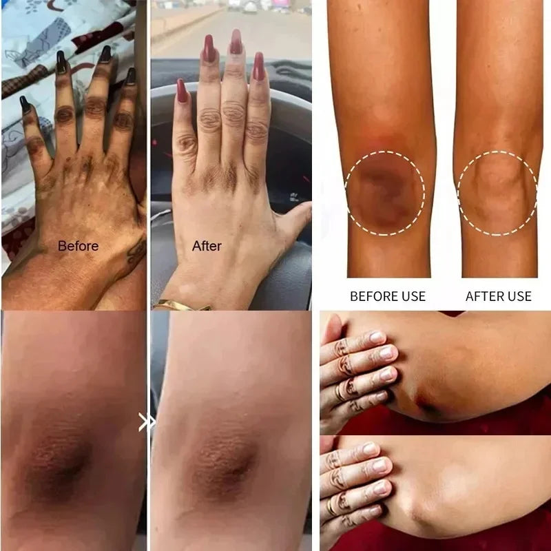 Body Whitening Lotion Dark Spot Remover For Underarms Knees Elbows Melanin Bleaching Lightening Skin Moisturizing Cream Qme