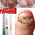 Nail Fungal Treatment Serum Foot Toe Nail Fungus Removal Essential Oil Anti Infection Onychomycosis Paronychia Repairing Care Qme 1pc