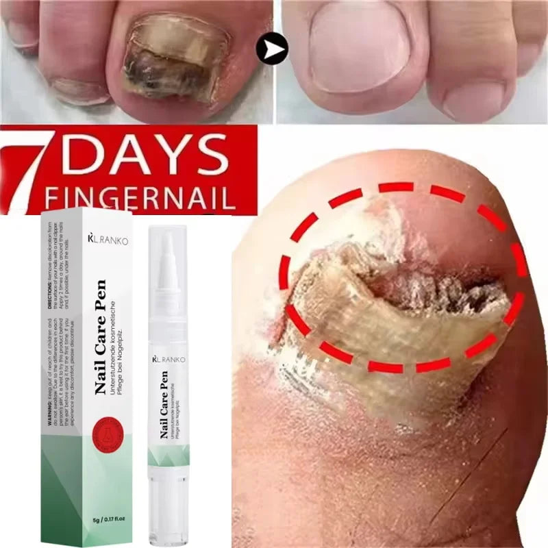 Nail Fungal Treatment Serum Foot Toe Nail Fungus Removal Essential Oil Anti Infection Onychomycosis Paronychia Repairing Care Qme 1pc