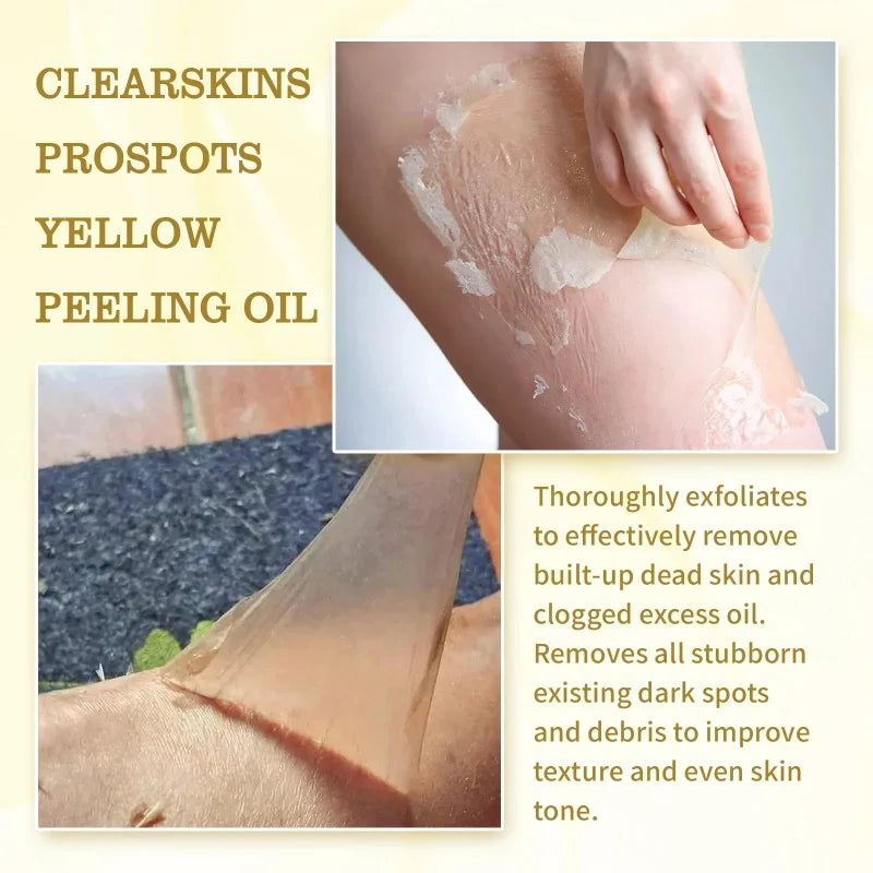 Strong Yellow Peeling Oil Bleach Dark Skin Whiten Lotion Lighten Body Elbow Knee Hand Exfoliate Dead Skin Nourish Even Skin Tone Qme