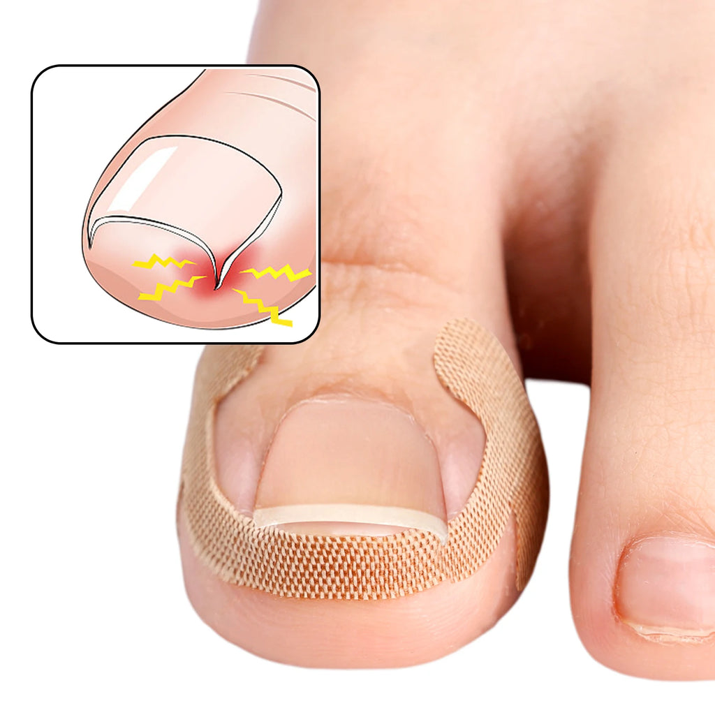 100PCS Ingrown Toenail Correction Strips Lasting Adhesion Waterproof Nail Correction Stickers Elasticity Toe Care Pedicure Tools Qme
