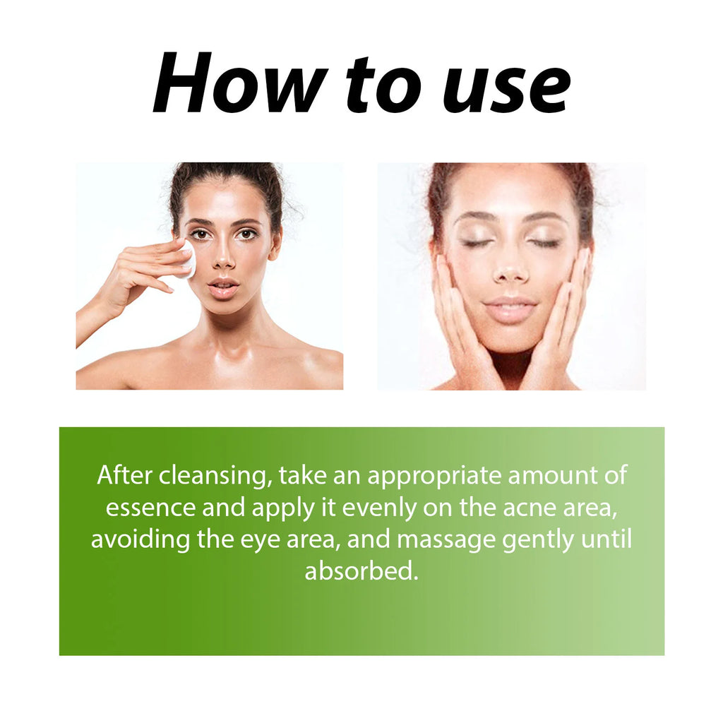Acne Face Cream Pimple Treatment Oil Control Repair Redness Remove Blackhead Smooth Hydrating Moisturizing Pore Shrinking Serum Qme