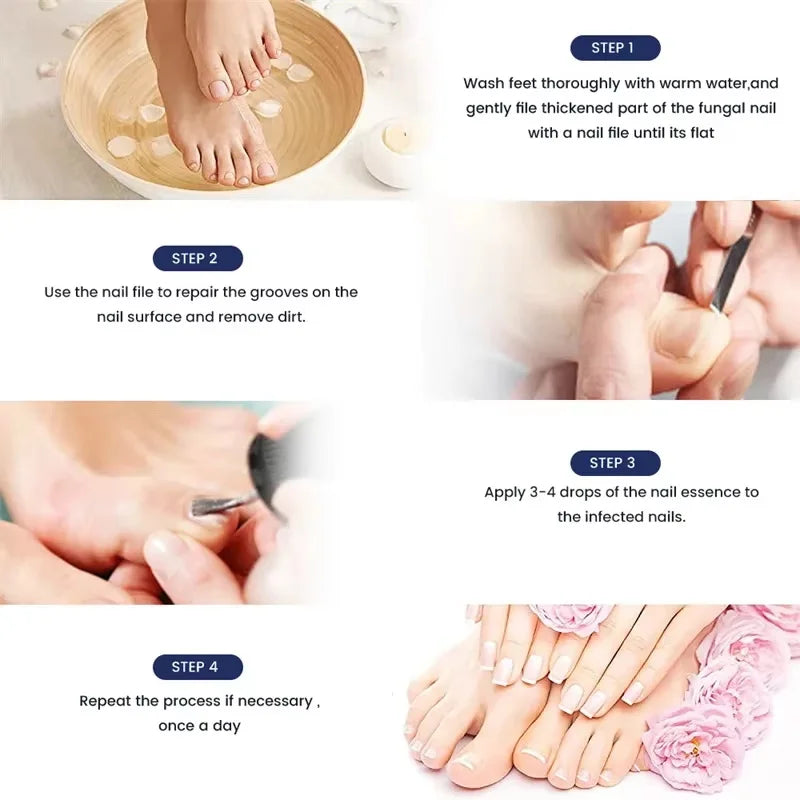 Fungal Nail Treatment Serum Foot Nail Fungus Removal Repair Gel Anti Infection Paronychia Onychomycosis Foot Nails Care Essence Qme