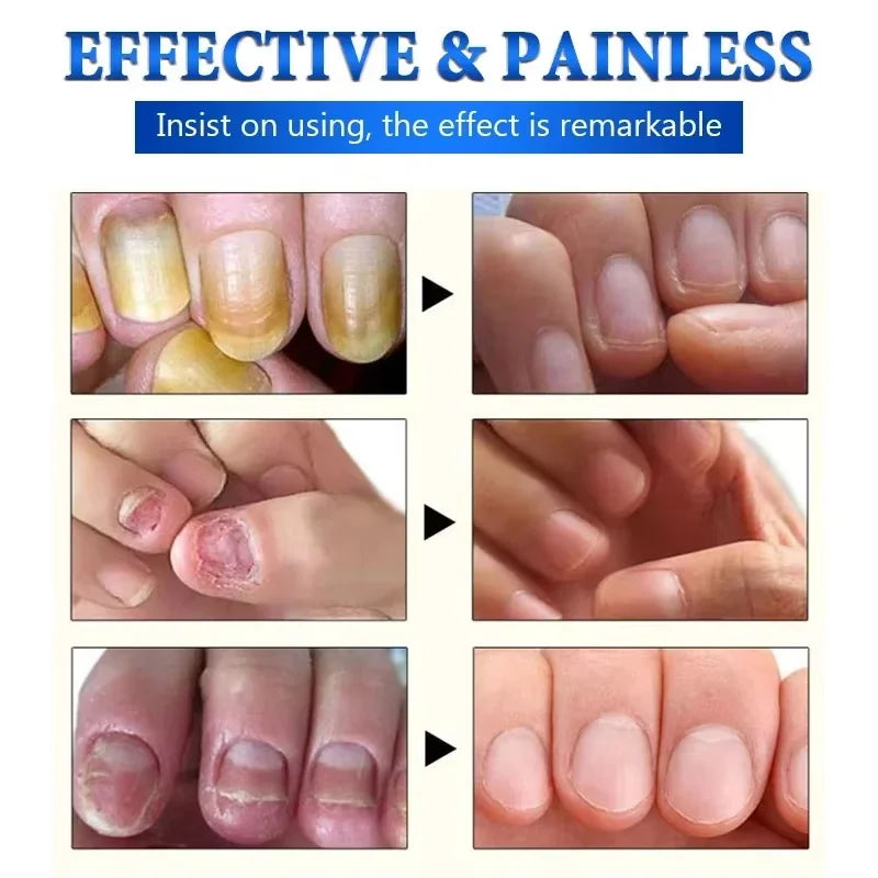 Fungal Nail Treatment Serum Foot Nail Fungus Removal Repair Gel Anti Infection Paronychia Onychomycosis Foot Nails Care Essence Qme