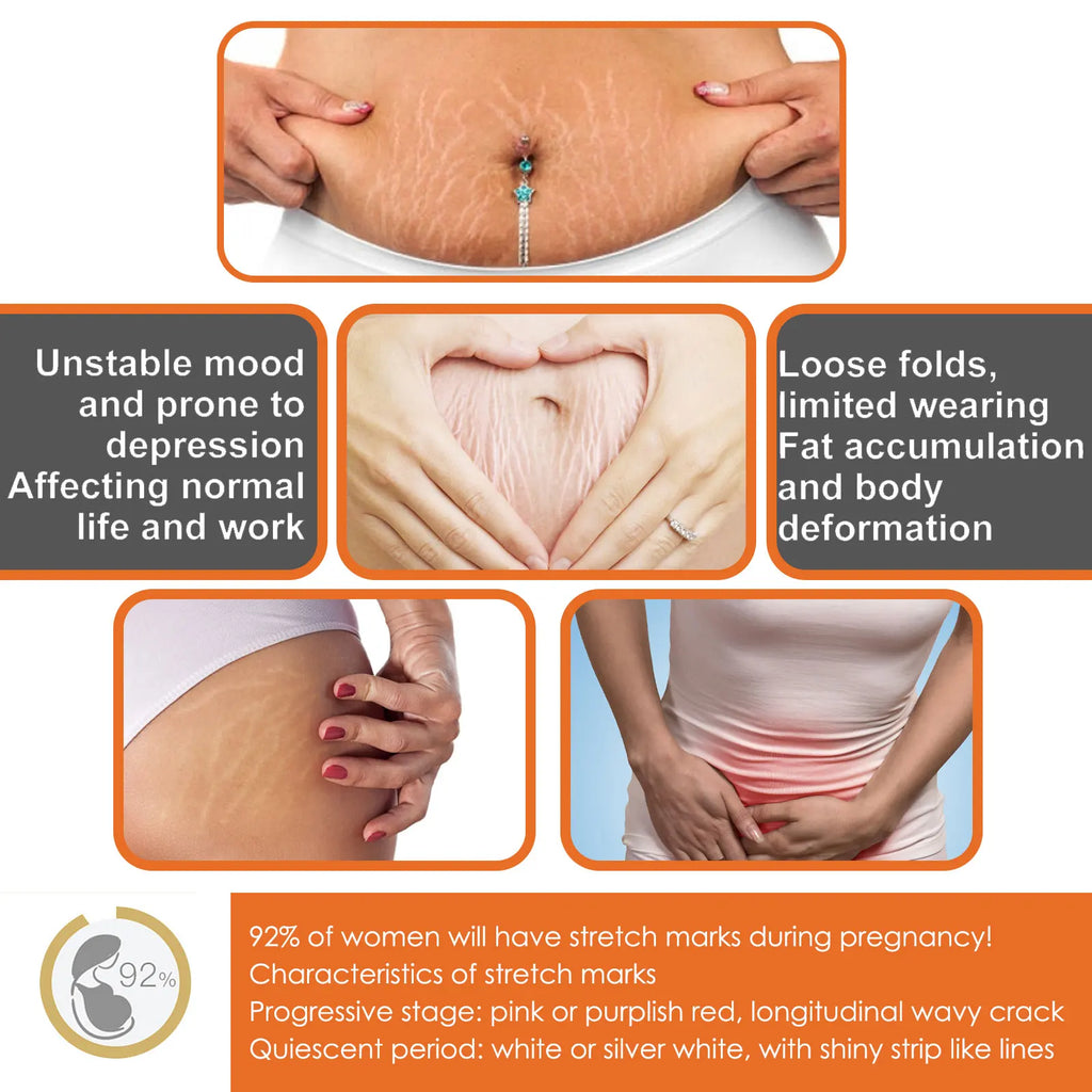 100g Stretch Marks Permanent Removal Cream Maternity Pregnant Women Pregnancy Anti-Winkle Smooth Repair Firming Skin Body Care Qme
