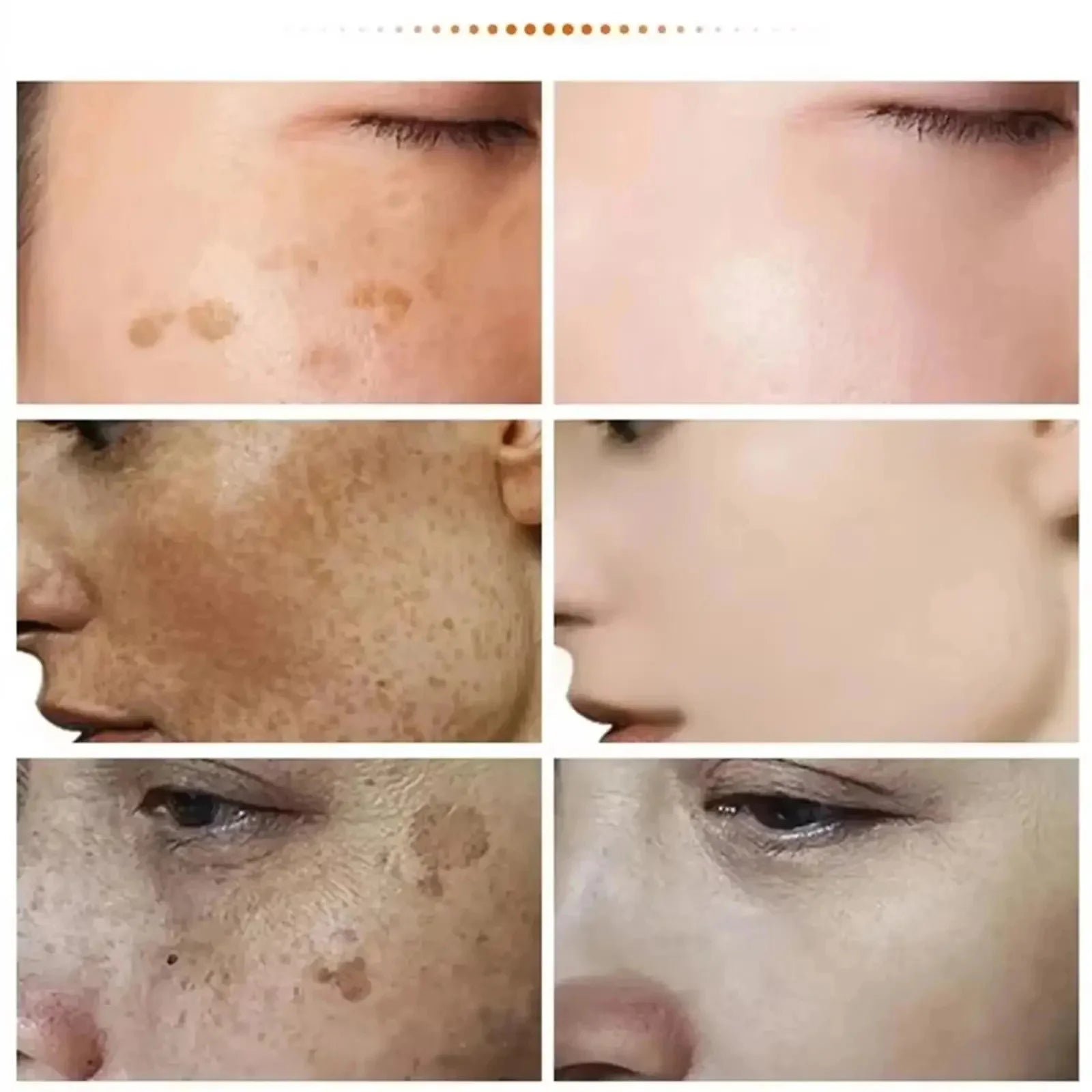 Whitening Freckle Cream Reduce Dark Spots Anti Freckle Face Creams Niacinamide Fade Pigmentation Melasma Brighten Skin Care 20g Qme